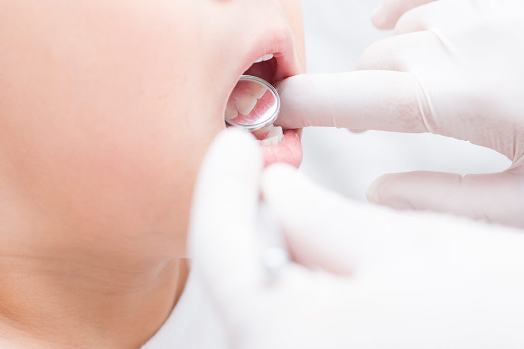 小倉南区・そね歯科クリニック・むし歯の放置は歯並びにも影響します