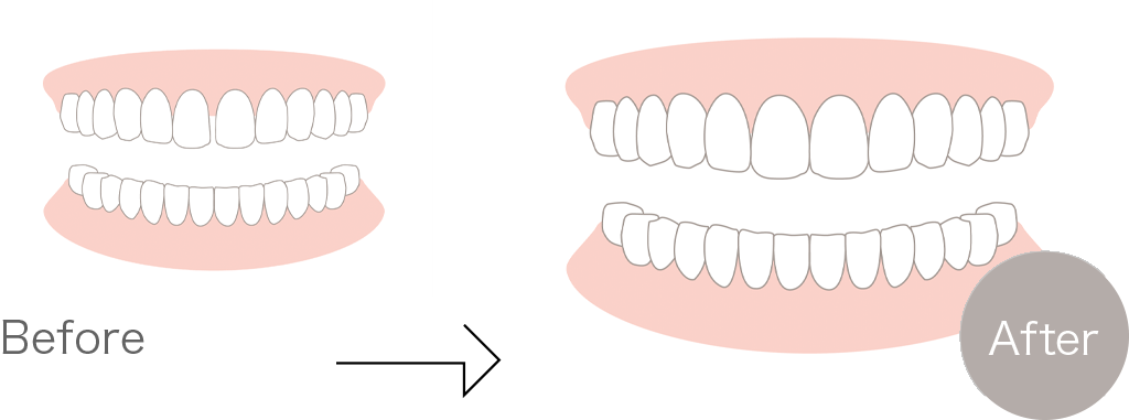 小倉南区・そね歯科クリニック・歯の隙間を埋める治療